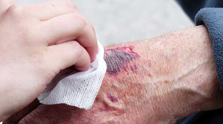 benefits of turmeric for wounds