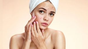 tips to deal with acne